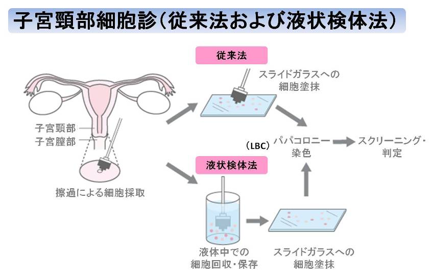 検診 子 ん 宮頸 が 子宮頸がん