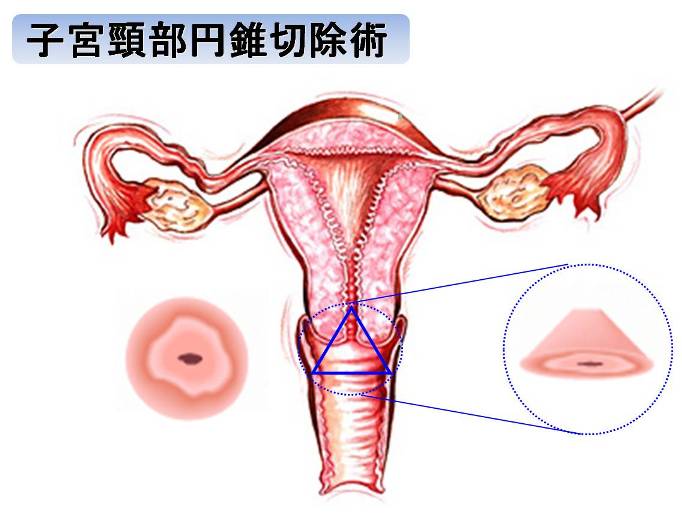 子宮頸部円錐切除術